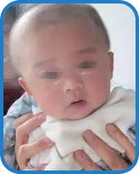 幼儿面部白癜风康复案例图片