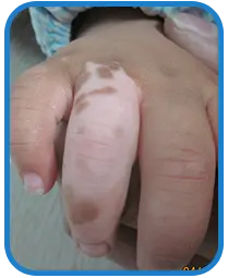 幼儿手背、指背部康复案例白斑