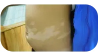幼儿腹部白斑