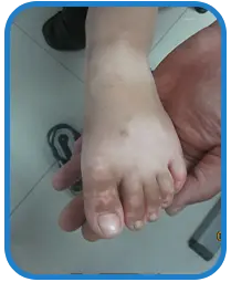 幼儿脚部白斑康复案例图片