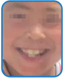 儿童面部白癜风白斑治疗案例图片