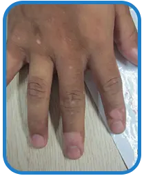 儿童手部白癜风白斑治疗案例图片