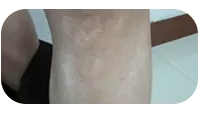 儿童腿部白斑治疗前图片