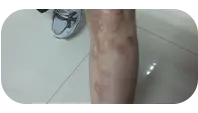 儿童腿部白斑治疗中图片