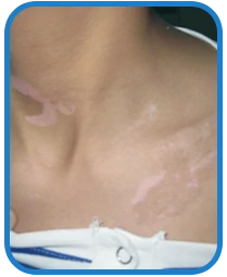 青少年颈部白癜风白斑治疗案例图片