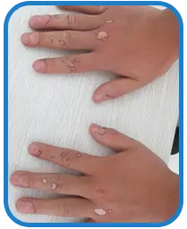 青少年手部白癜风白斑治疗案例图片