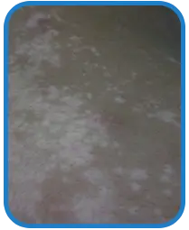 青少年背部白癜风白斑治疗案例图片