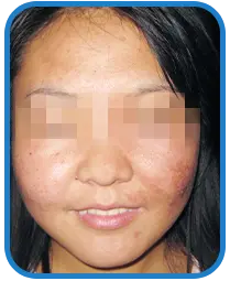 女性面部白癜风康复案例图片