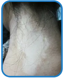 女性颈部白癜风康复案例图片