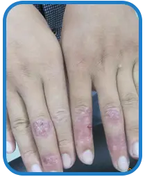 女性手部白癜风康复案例图片