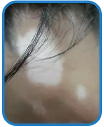 女性背部白癜风康复案例图片