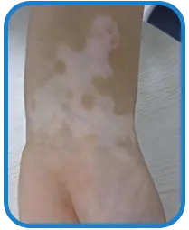 女性四肢白癜风康复案例图片