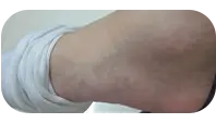 女性脚部白癜风治疗后图片