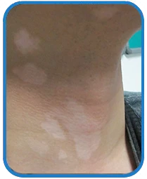 男性颈部白癜风康复案例图片