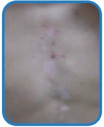 男性胸部白癜风康复案例图片