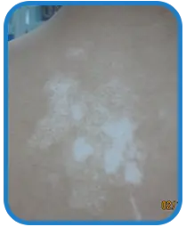 男性背部白癜风康复案例图片