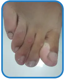 男性脚部白癜风康复案例图片