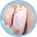 儿童白斑白癜风